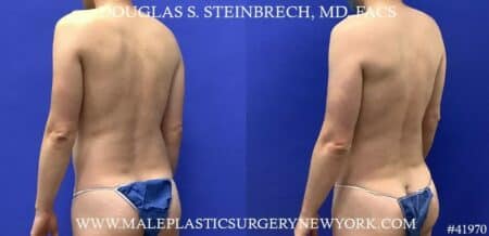 Liposuction with body banking to enhance the pecs by Dr. Steinbrech.