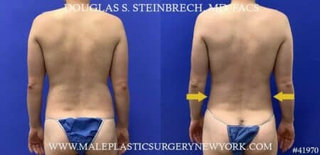 Liposuction with body banking to enhance the pecs by Dr. Steinbrech.