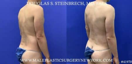 Liposuction with body banking to enhance the pecs by Dr. Steinbrech.