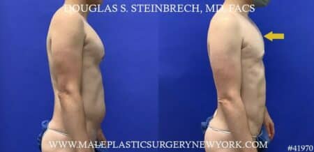 Liposuction with body banking to enhance the pecs by Dr. Steinbrech.