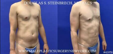 Liposuction with body banking to enhance the pecs by Dr. Steinbrech.