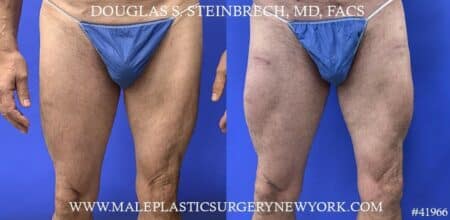 Quad augmentation to enhance the upper leg of a male patient by Dr. Steinbrech