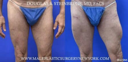 Quad augmentation to enhance the upper leg of a male patient by Dr. Steinbrech