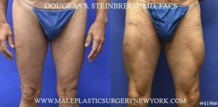 Quad augmentation to enhance the upper leg of a male patient by Dr. Steinbrech