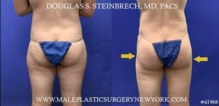 Body banking to masculinize hips by Dr. Steinbrech