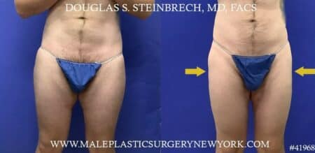 Body banking to masculinize hips by Dr. Steinbrech