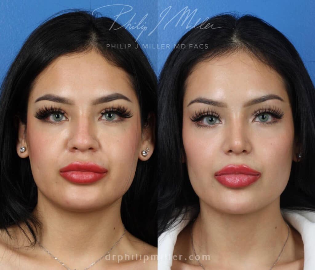 Rhinoplasty with buccal fat pad removal for facial enhancement by Dr. Miller. Surgery creates a more proportionate nose and slimmer lower face for a more attractive facial contour.