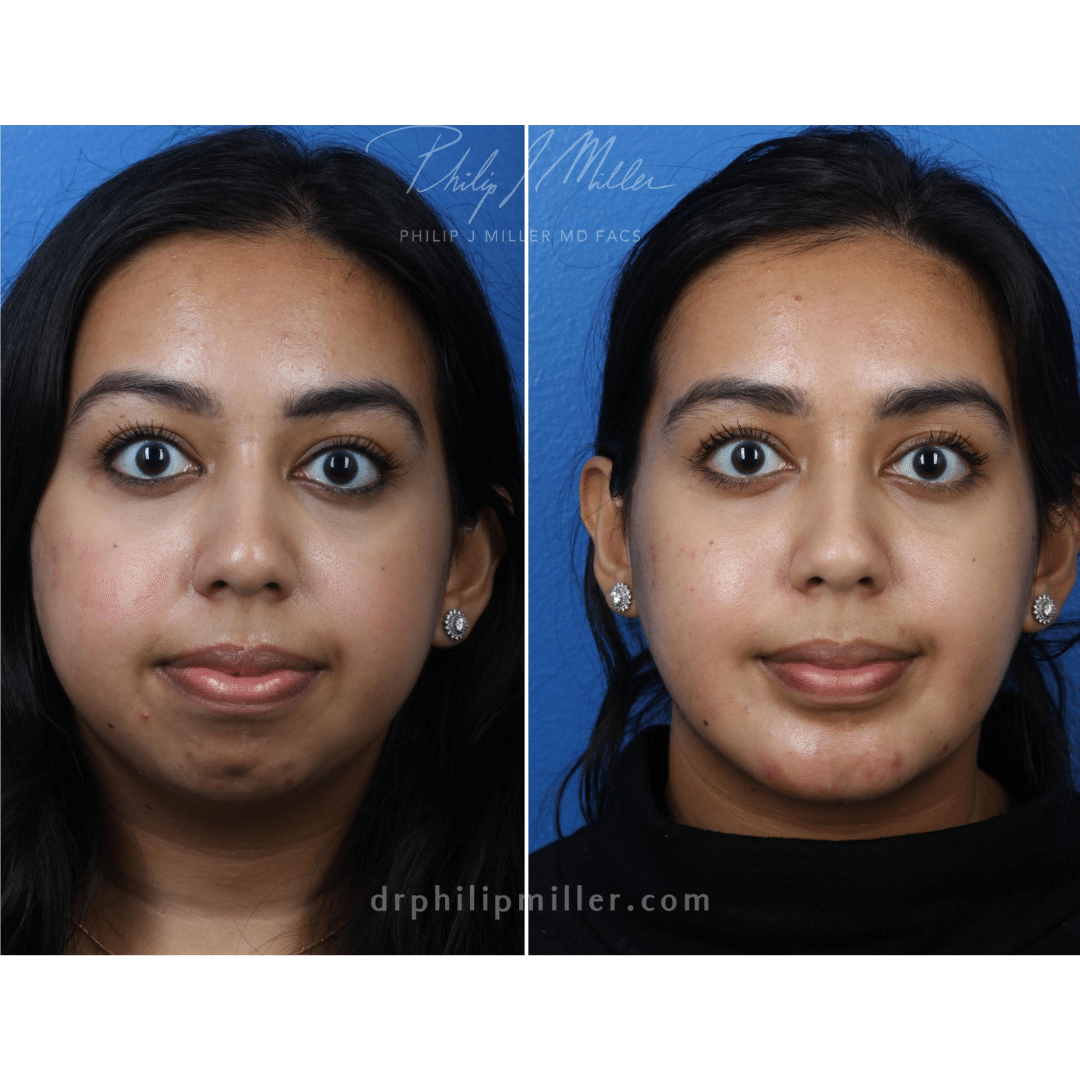Chin implant for lower face contouring by Dr. Miller. After surgery, chin is stronger and more proportionate to other facial features.