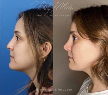 Rhinoplasty to enhance the nose, 9 months post-op, by Dr. Miller