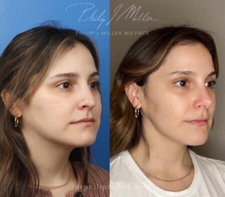 Rhinoplasty to enhance the nose, 9 months post-op, by Dr. Miller