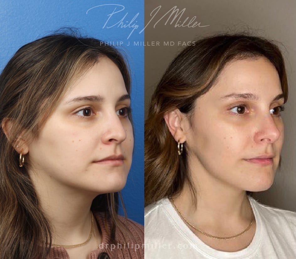 Rhinoplasty to enhance the nose, 9 months post-op, by Dr. Miller. Surgery straightens bridge and slightly rotates tip for a more pleasing profile.