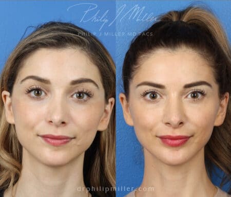 Revision rhinoplasty with chin implant to improve facial profile by Dr. Miller