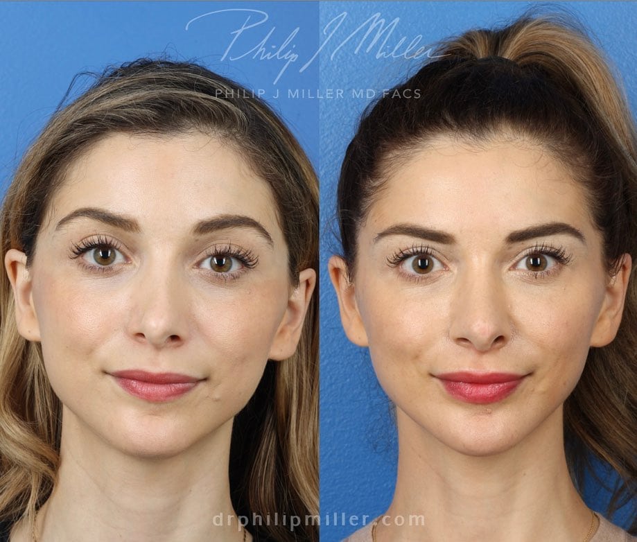 Revision rhinoplasty with chin implant to improve facial profile by Dr. Miller. Surgery refines nasal tip and adds definition to jawline for a more attractive profile.