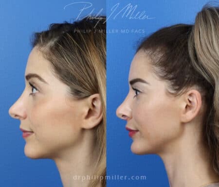 Revision rhinoplasty with chin implant to improve facial profile by Dr. Miller