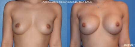 Breast augmentation using silicone implants by Dr. Steinbrech