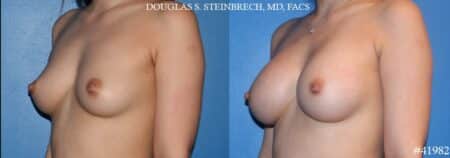 Breast augmentation using silicone implants by Dr. Steinbrech