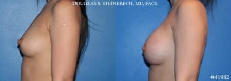 Breast augmentation using silicone implants by Dr. Steinbrech