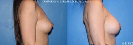 Breast augmentation using silicone implants by Dr. Steinbrech