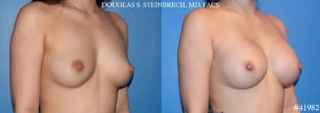 Breast augmentation using silicone implants by Dr. Steinbrech