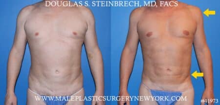 Flank tuck with body banking to the pecs and shoulders by Dr. Steinbrech