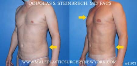 Flank tuck with body banking to the pecs and shoulders by Dr. Steinbrech