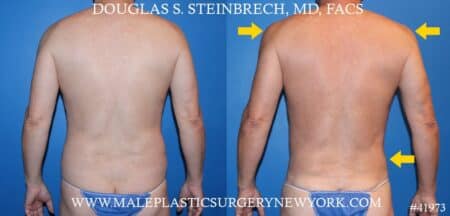 Flank tuck with body banking to the pecs and shoulders by Dr. Steinbrech