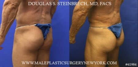 Gluteal implants to enhance the size and shape of the buttocks by Dr. Steinbrech