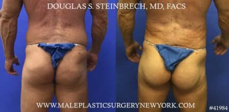 Gluteal implants to enhance the size and shape of the buttocks by Dr. Steinbrech