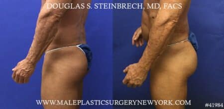 Gluteal implants to enhance the size and shape of the buttocks by Dr. Steinbrech