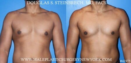 Gynecomastia treatment to enhance the appearance of the male chest by Dr. Steinbrech