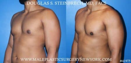 Gynecomastia treatment to enhance the appearance of the male chest by Dr. Steinbrech