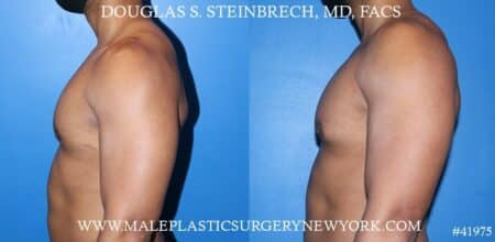 Gynecomastia treatment to enhance the appearance of the male chest by Dr. Steinbrech