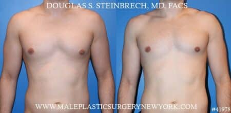 Gynecomastia treatment to enhance the contour of the male chest by Dr. Steinbrech