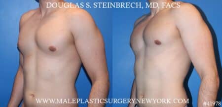 Gynecomastia treatment to enhance the contour of the male chest by Dr. Steinbrech