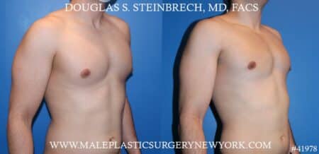 Gynecomastia treatment to enhance the contour of the male chest by Dr. Steinbrech