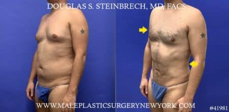 Liposuction with body banking to pecs and glutes by Dr. Steinbrech