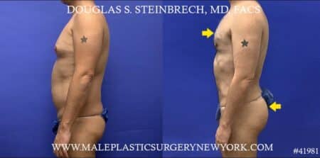 Liposuction with body banking to pecs and glutes by Dr. Steinbrech