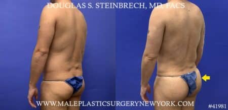 Liposuction with body banking to pecs and glutes by Dr. Steinbrech