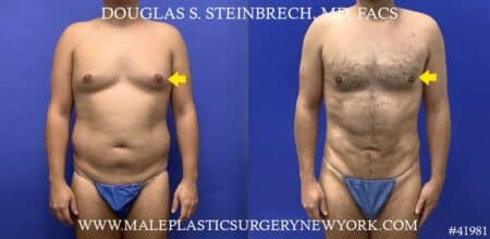 Liposuction with body banking to pecs and glutes by Dr. Steinbrech