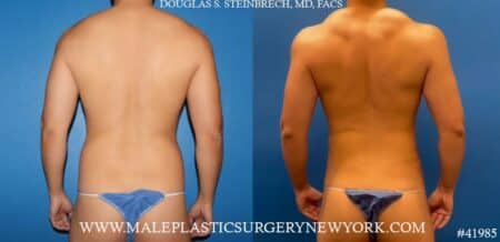 Liposuction with body banking to the traps and shoulders by Dr. Steinbrech