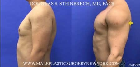 Pec, Bicep, Shoulder, and Tricep Implants, Body Banking to Traps by Dr. Steinbrech