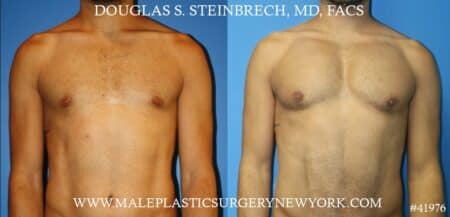 Pectoral implants to enhance the appearance of the male chest by Dr. Steinbrech