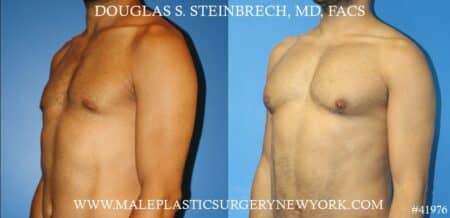 Pectoral implants to enhance the appearance of the male chest by Dr. Steinbrech