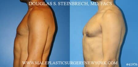 Pectoral implants to enhance the appearance of the male chest by Dr. Steinbrech