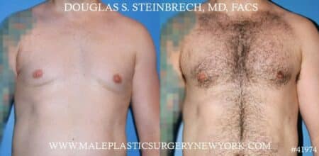 Pectoral implants to sculpt the male chest by Dr. Steinbrech