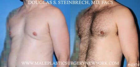 Pectoral implants to sculpt the male chest by Dr. Steinbrech