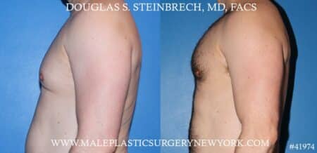 Pectoral implants to sculpt the male chest by Dr. Steinbrech