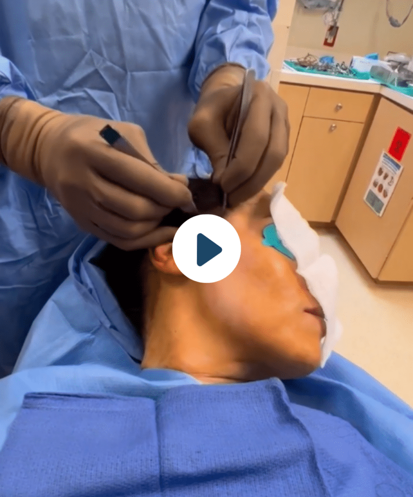 ponytail lift procedure in new york