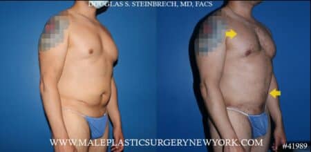 270° torso tuck with body banking to pecs, shoulders, and glutes by Dr. Steinbrech