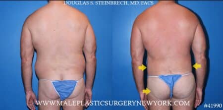 360° torso tuck with body banking to pecs and glutes by Dr. Steinbrech